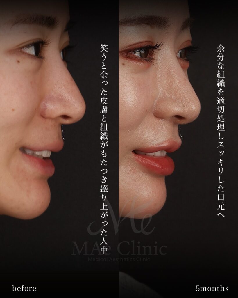裏側人中短縮 人中厚み調整3D Cカール 中顔面短縮 術後5ヶ月 前田翔医師症例