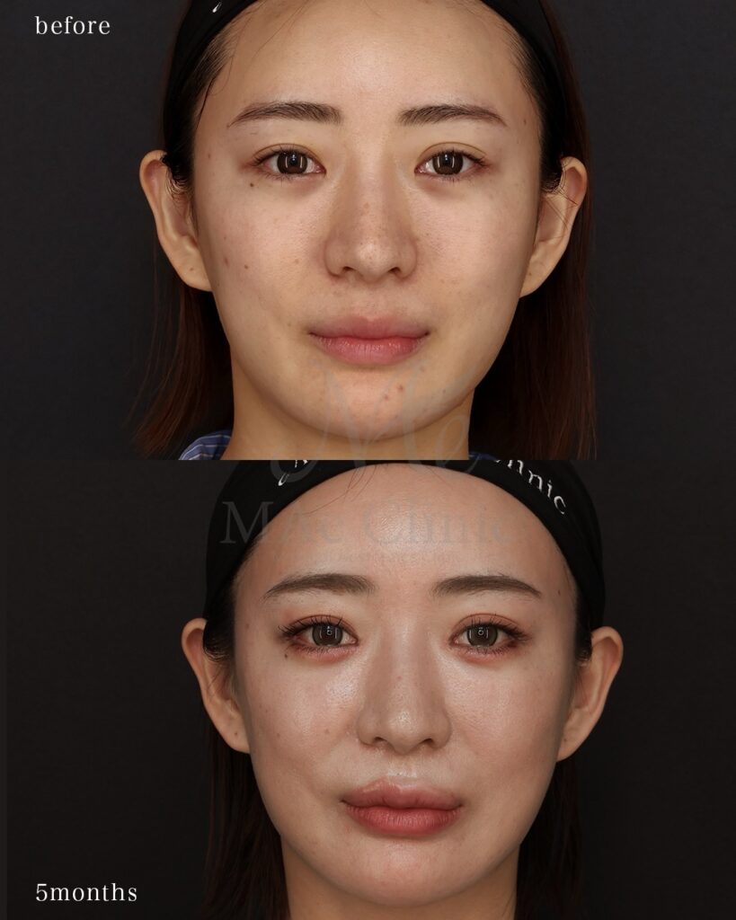 裏側人中短縮 人中厚み調整3D Cカール 中顔面短縮 術後5ヶ月 前田翔医師症例