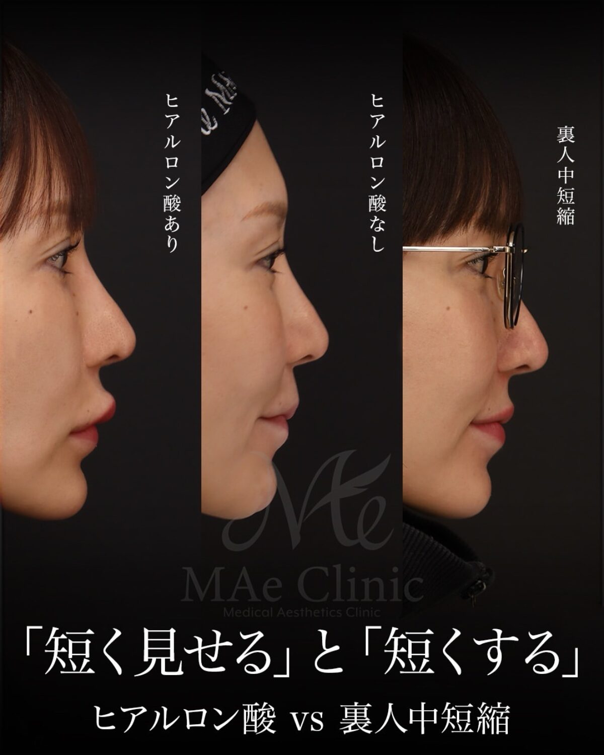 ヒアルロン酸溶解から裏側人中短縮・口角挙上で口元を立体化した前田翔