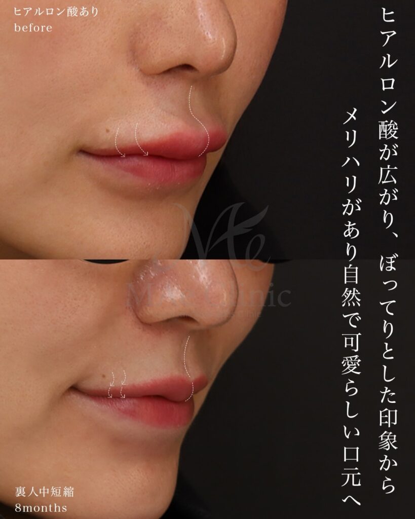 裏側人中短縮 人中厚み調整3D 口角挙上 ヒアルロン酸溶解 術後8ヶ月 前田翔医師症例