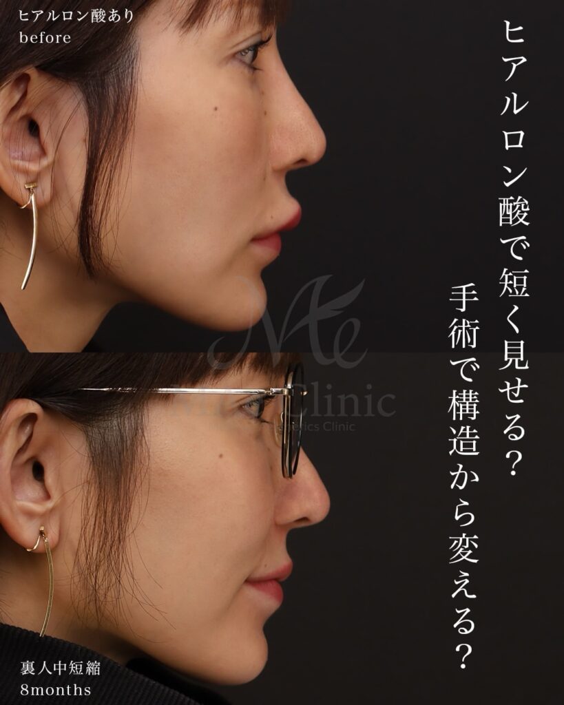 裏側人中短縮 人中厚み調整3D 口角挙上 ヒアルロン酸溶解 術後8ヶ月 前田翔医師症例