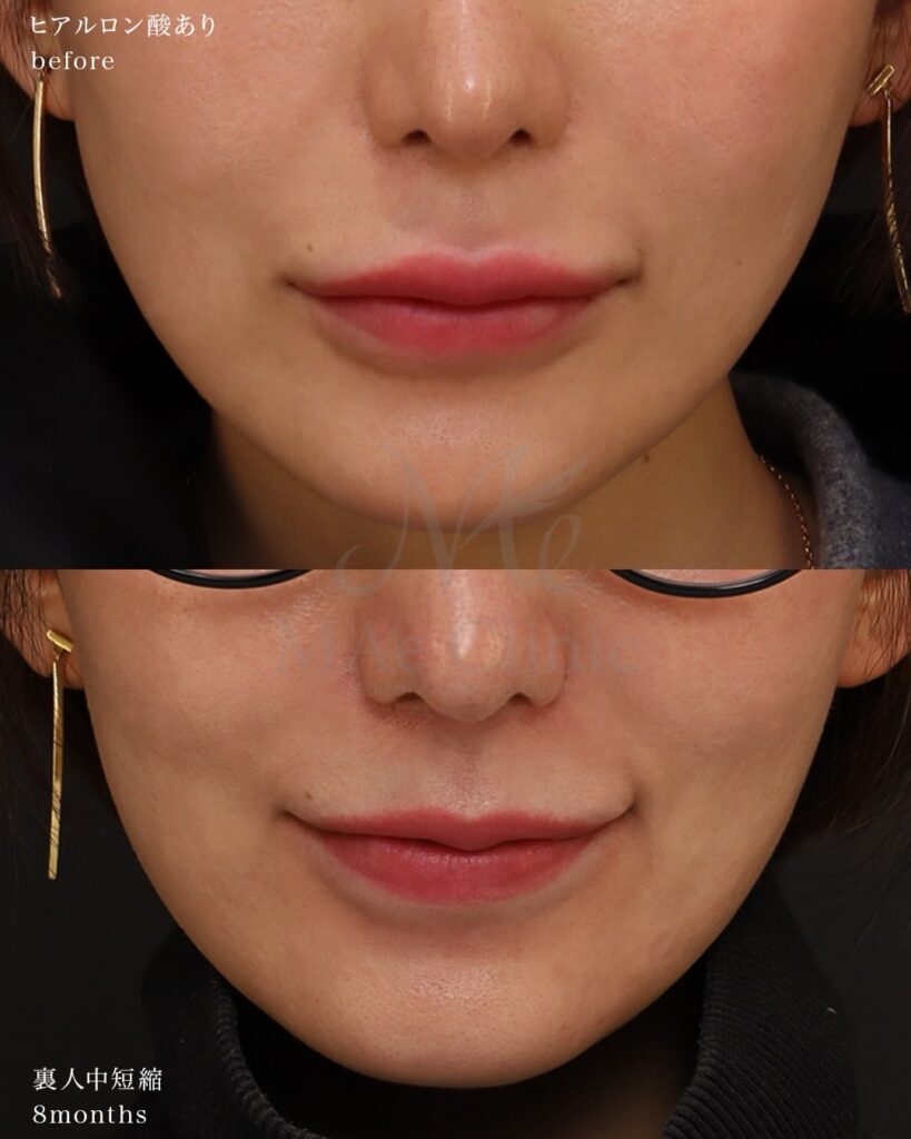 裏側人中短縮 人中厚み調整3D 口角挙上 ヒアルロン酸溶解 術後8ヶ月 前田翔医師症例