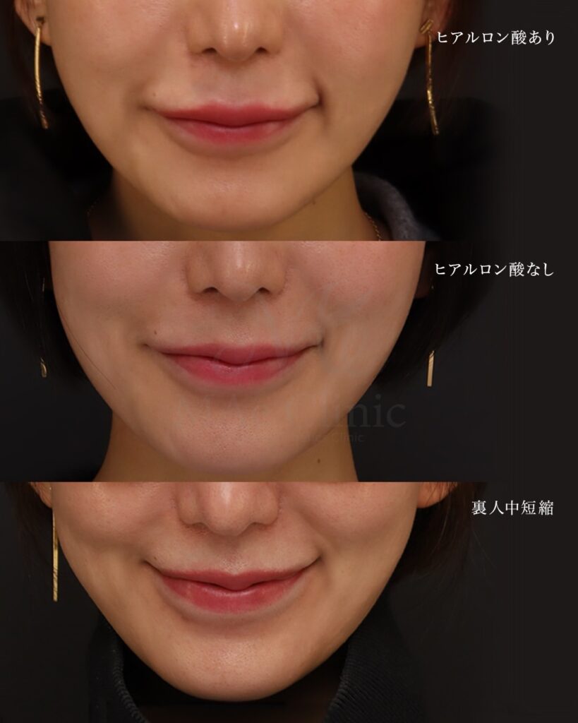 裏側人中短縮 人中厚み調整3D 口角挙上 ヒアルロン酸溶解 術後8ヶ月 前田翔医師症例
