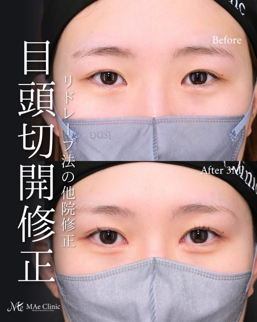 目頭切開 他院修正 リドレープ法 目頭の丸み改善 左右差 術後3ヶ月 前之園健太医師症例