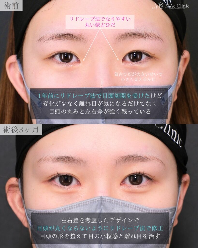 目頭切開 他院修正 リドレープ法 目頭の丸み改善 左右差 術後3ヶ月 前之園健太医師症例