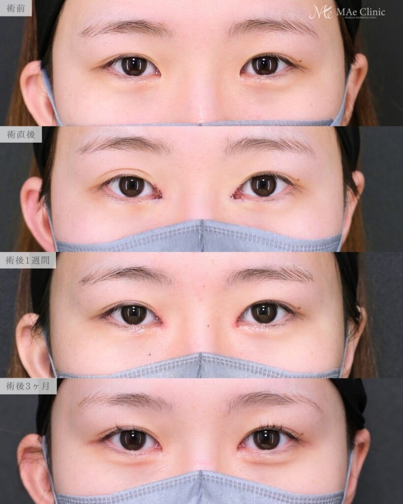 目頭切開 他院修正 リドレープ法 目頭の丸み改善 左右差 術後3ヶ月 前之園健太医師症例