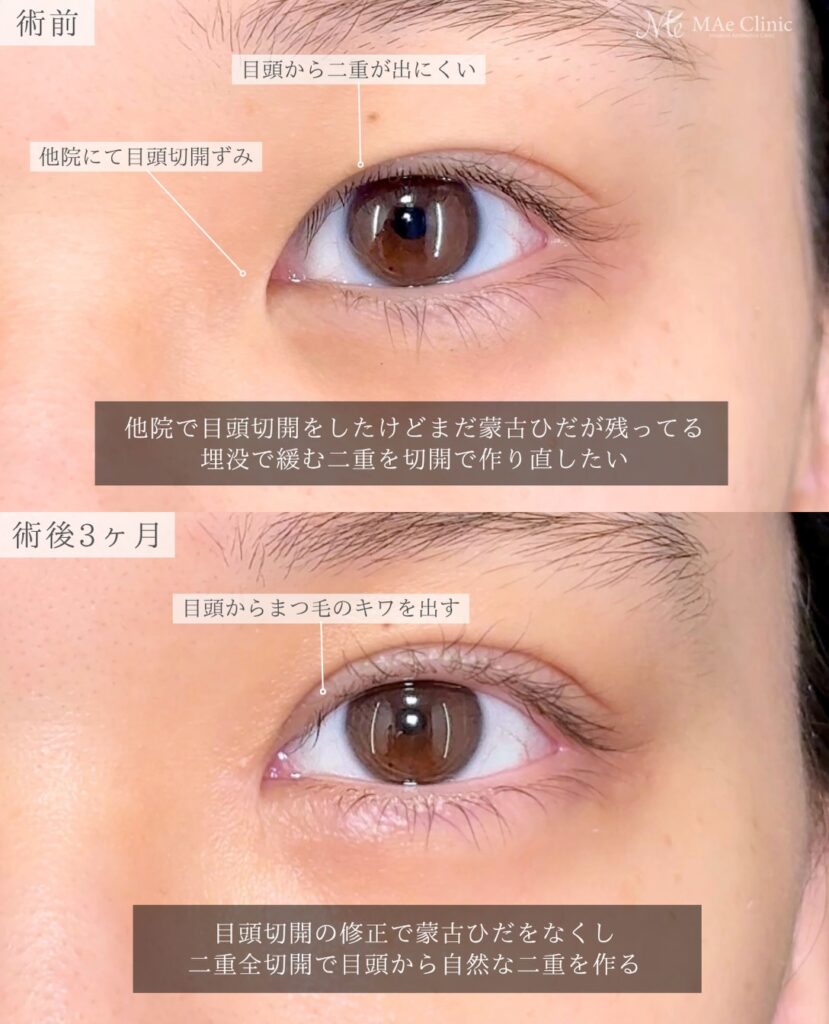 目頭切開他院修正 Z法 二重全切開 蒙古ひだ改善 二重幅修正 前之園健太医師症例