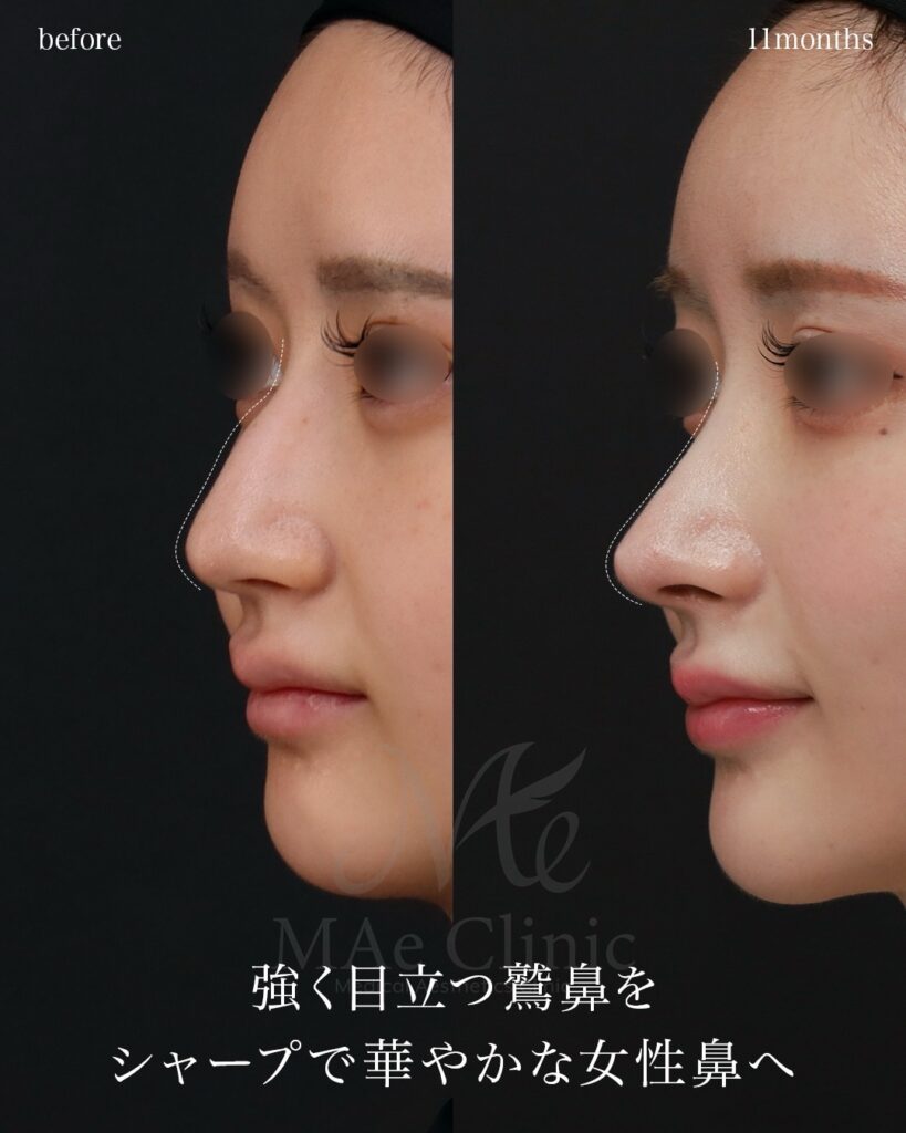 鷲鼻削り 鼻骨骨切り 鼻尖形成 ストラット法 術後11ヶ月 骨格調和 前田翔医師症例