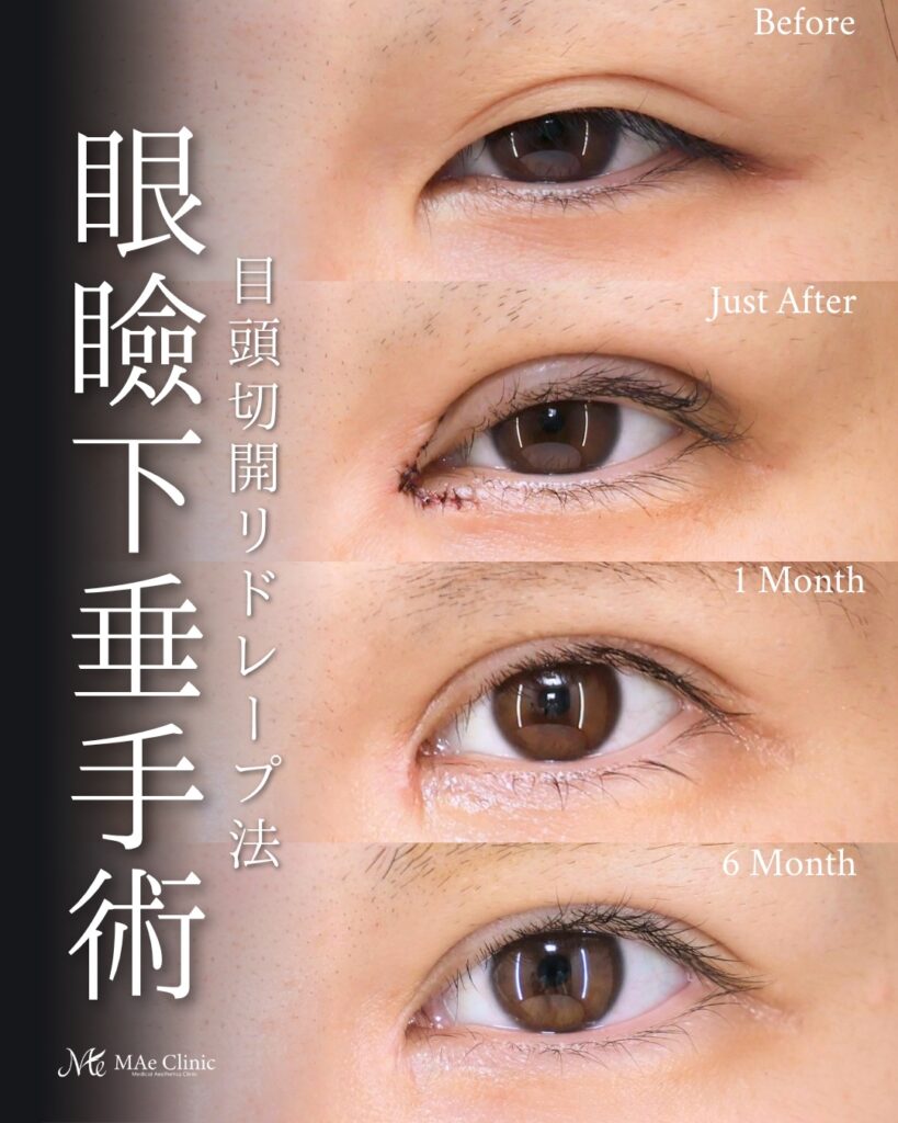 眼瞼下垂手術 目頭切開 リドレープ法 Mix二重 目の開き改善 前之園健太医師症例