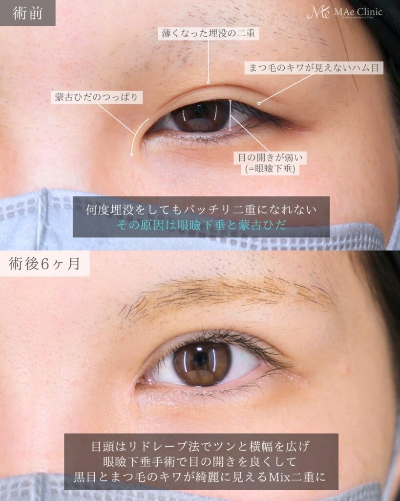 眼瞼下垂手術 目頭切開 リドレープ法 Mix二重 目の開き改善 前之園健太医師症例