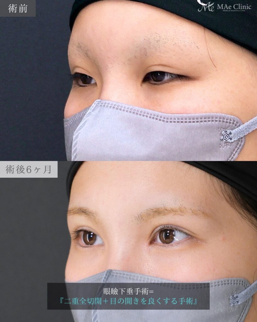 眼瞼下垂手術 目頭切開 リドレープ法 Mix二重 目の開き改善 前之園健太医師症例