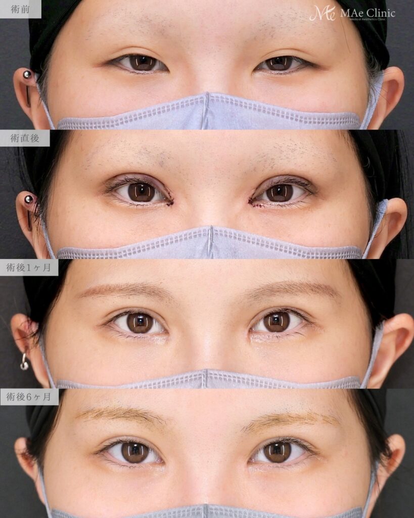 眼瞼下垂手術 目頭切開 リドレープ法 Mix二重 目の開き改善 前之園健太医師症例