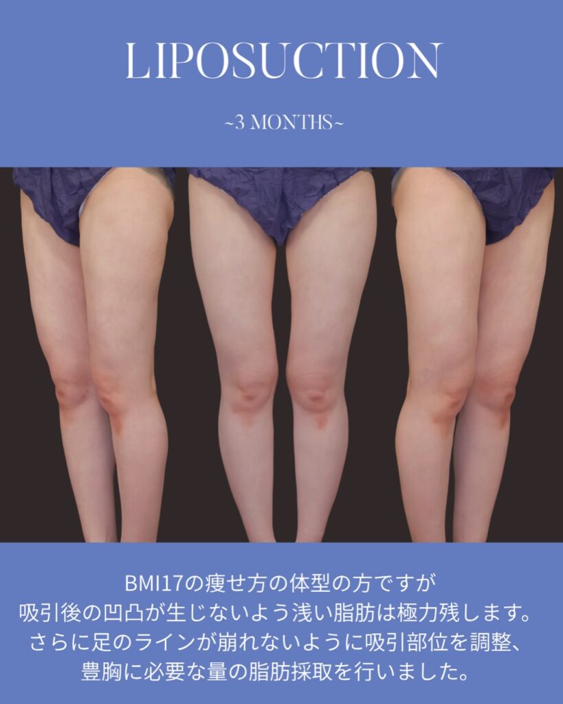 コンデンスリッチ脂肪注入豊胸 BMI17 痩せ型 授乳後バスト改善 大腿脂肪吸引 2回法 木下恵里沙医師症例