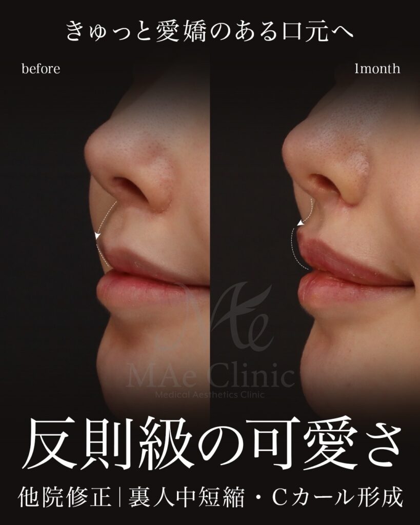 裏人中短縮 人中窩形成 人中厚み調整3D 鼻翼縮小 Cカール形成 術後1ヶ月 前田翔医師症例
