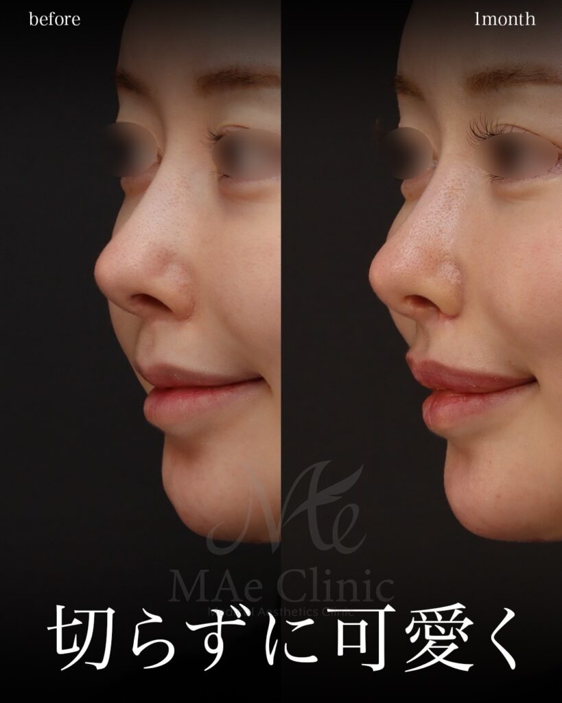 裏人中短縮 人中窩形成 人中厚み調整3D 鼻翼縮小 Cカール形成 術後1ヶ月 前田翔医師症例