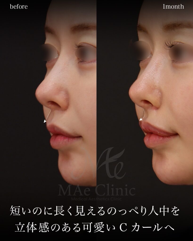 裏人中短縮 人中窩形成 人中厚み調整3D 鼻翼縮小 Cカール形成 術後1ヶ月 前田翔医師症例
