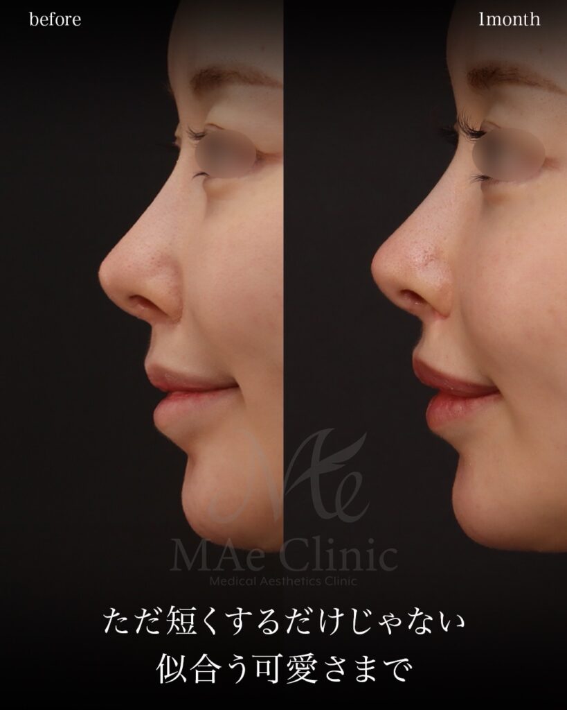 裏人中短縮 人中窩形成 人中厚み調整3D 鼻翼縮小 Cカール形成 術後1ヶ月 前田翔医師症例