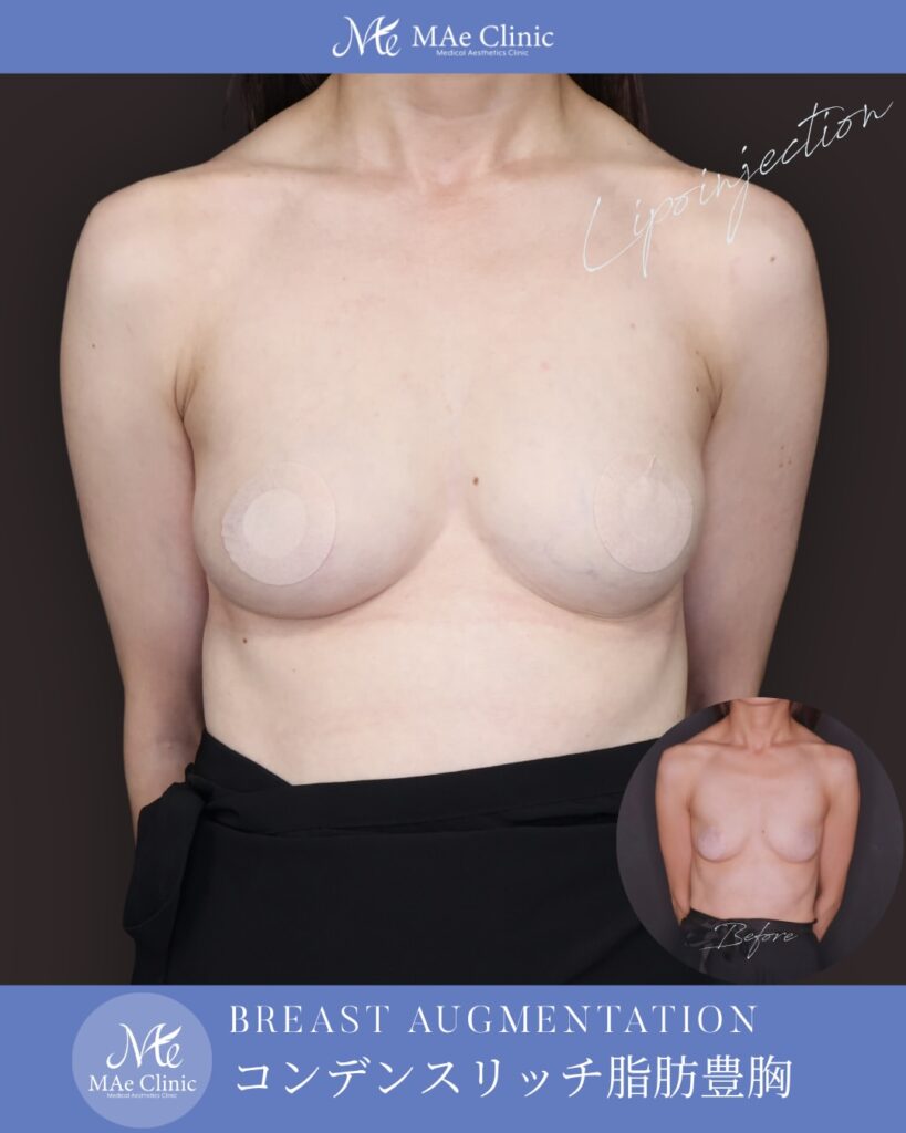 コンデンスリッチ脂肪注入豊胸 BMI17 痩せ型 授乳後バスト改善 大腿脂肪吸引 2回法 木下恵里沙医師症例