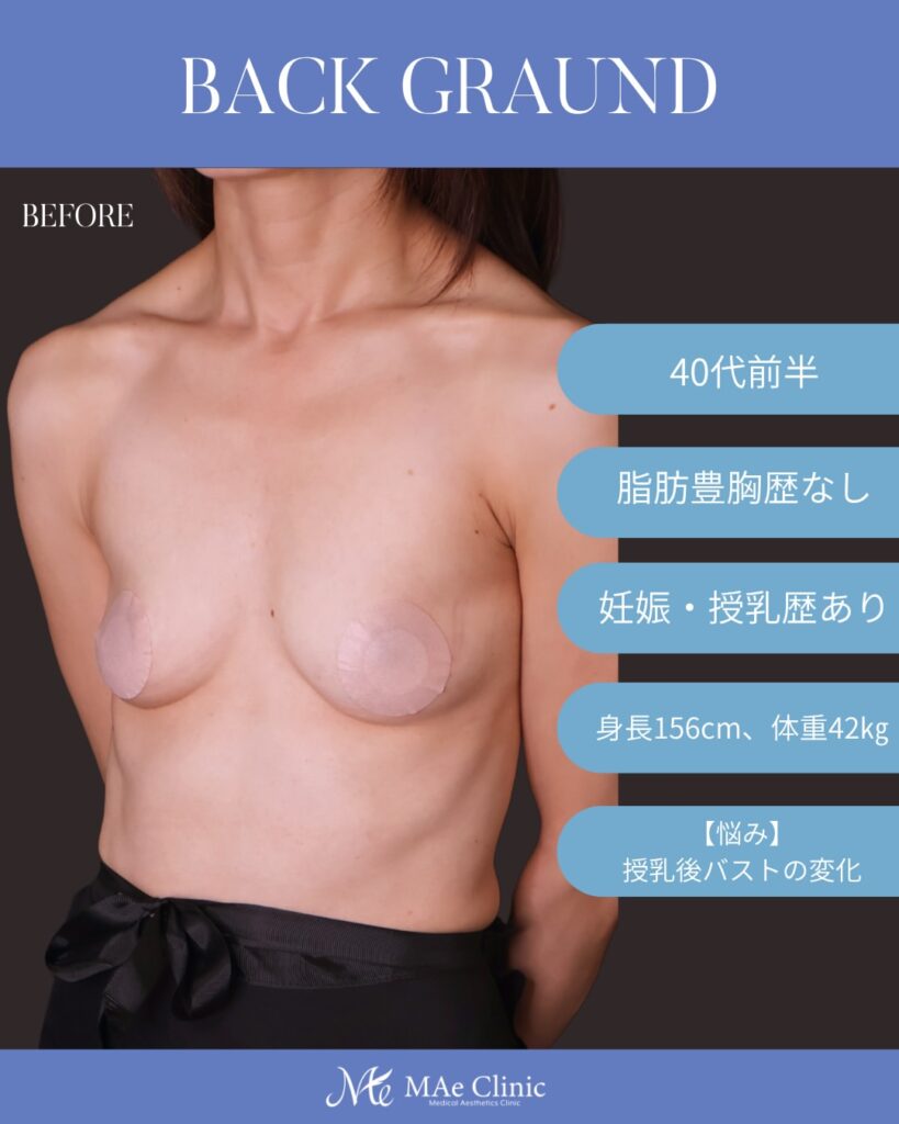 コンデンスリッチ脂肪注入豊胸 BMI17 痩せ型 授乳後バスト改善 大腿脂肪吸引 2回法 木下恵里沙医師症例