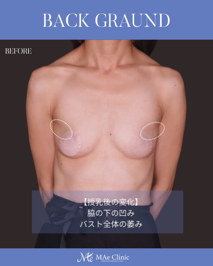 コンデンスリッチ脂肪注入豊胸 BMI17 痩せ型 授乳後バスト改善 大腿脂肪吸引 2回法 木下恵里沙医師症例