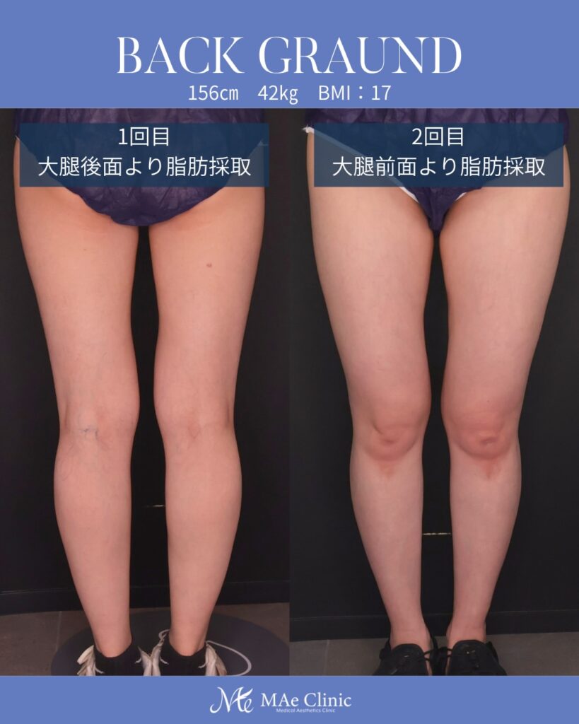 コンデンスリッチ脂肪注入豊胸 BMI17 痩せ型 授乳後バスト改善 大腿脂肪吸引 2回法 木下恵里沙医師症例