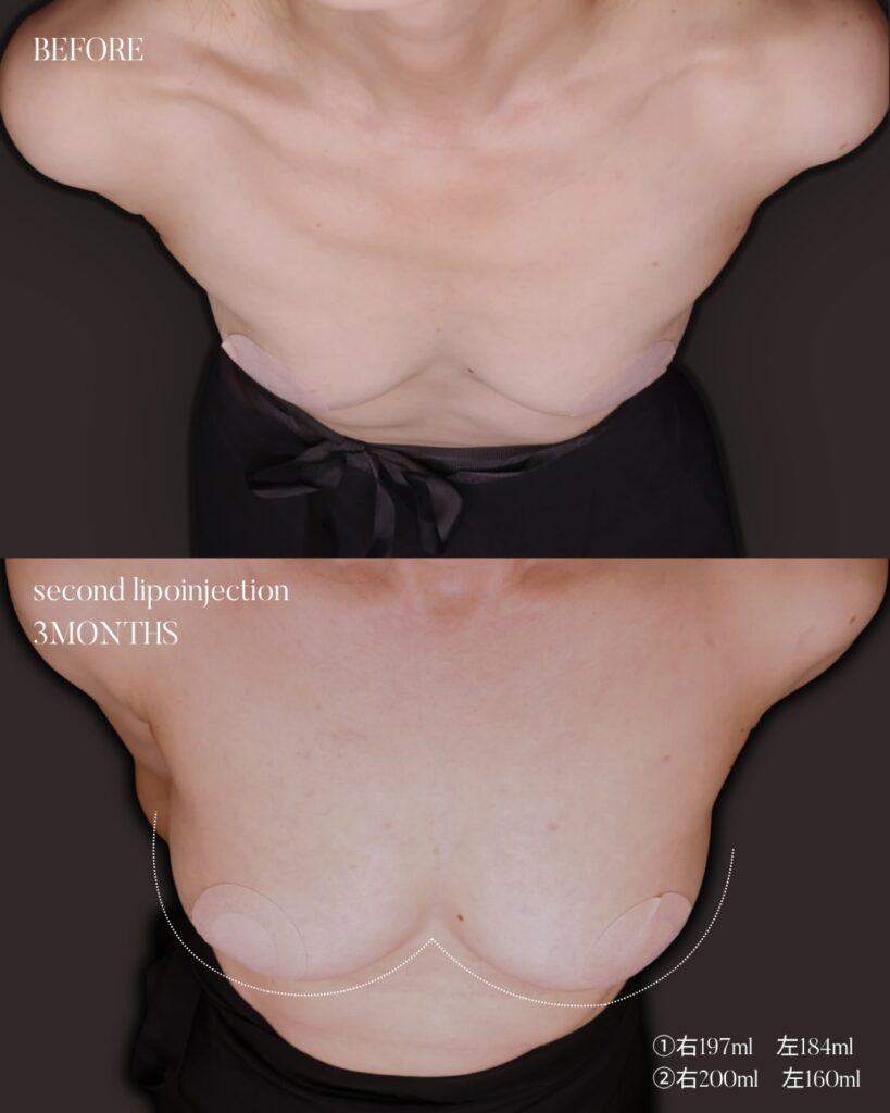コンデンスリッチ脂肪注入豊胸 BMI17 痩せ型 授乳後バスト改善 大腿脂肪吸引 2回法 木下恵里沙医師症例