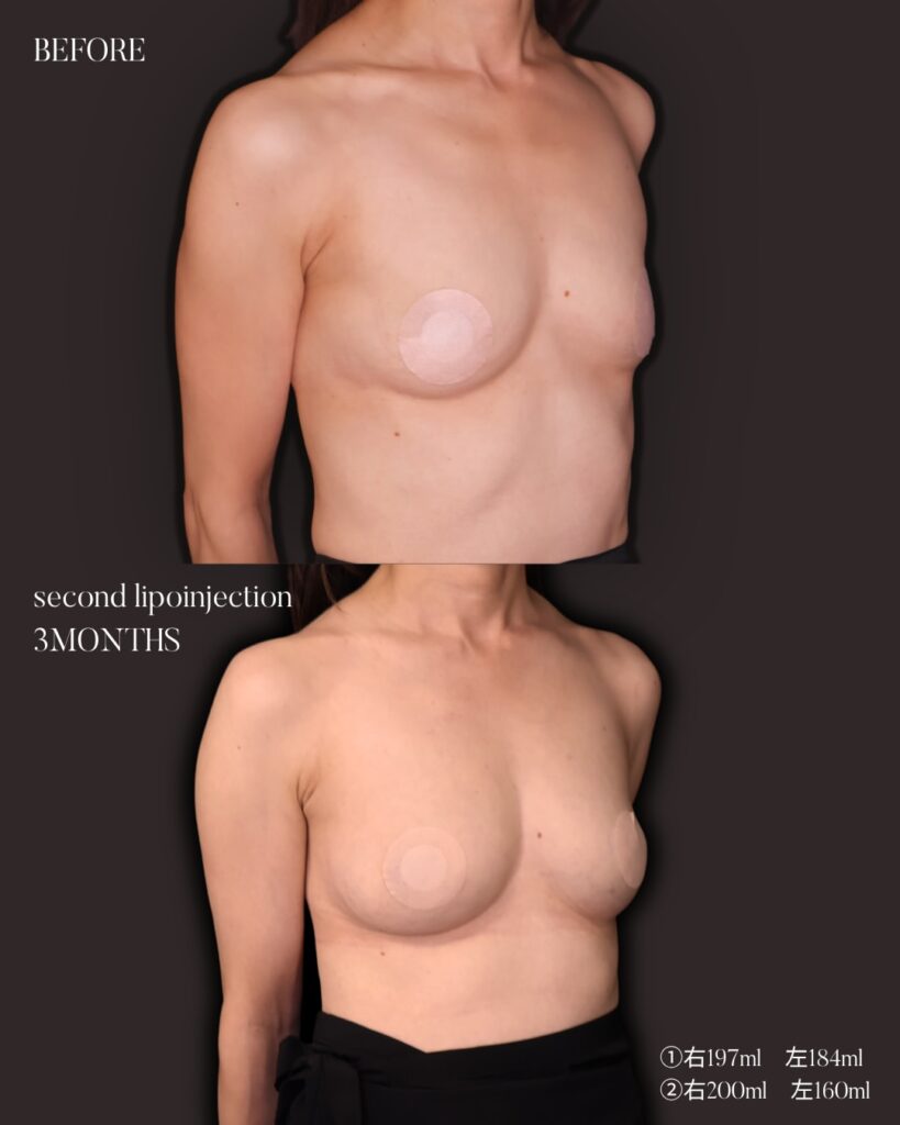 コンデンスリッチ脂肪注入豊胸 BMI17 痩せ型 授乳後バスト改善 大腿脂肪吸引 2回法 木下恵里沙医師症例