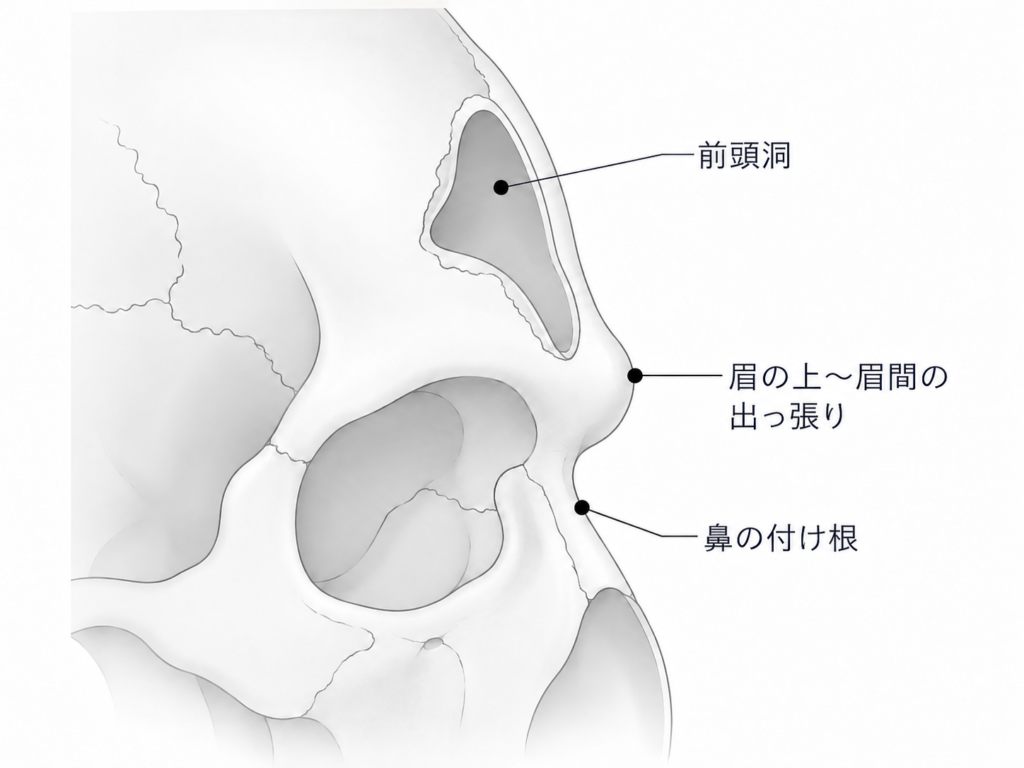 眉の上の骨の内側にある空洞(前頭洞)と、骨の出っ張りの位置関係を示した図