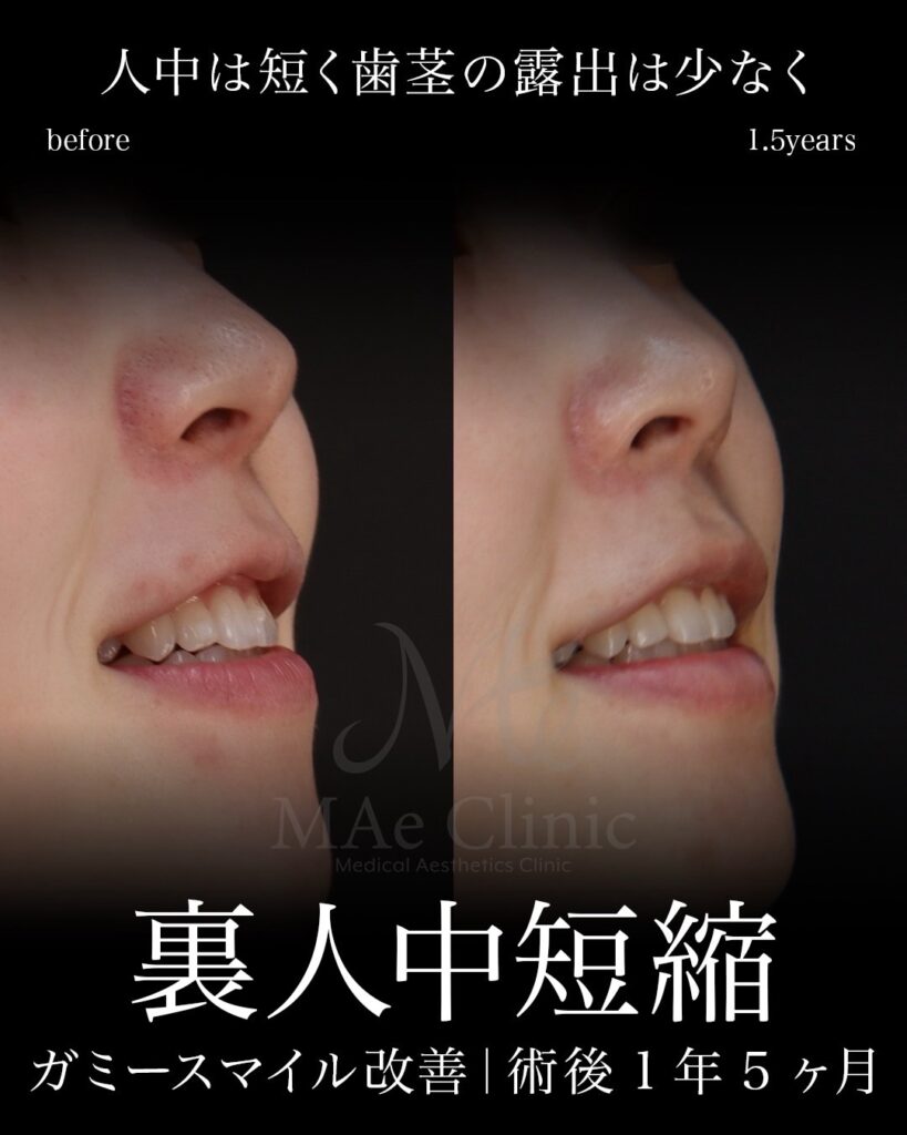 裏人中短縮 人中厚み調整3D ガミースマイル改善 Cカール 術後1年5ヶ月 前田翔医師症例