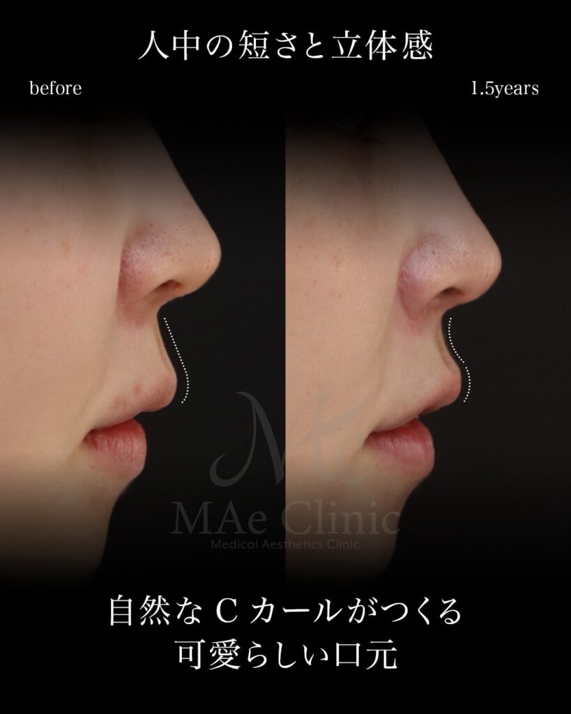 裏人中短縮 人中厚み調整3D ガミースマイル改善 Cカール 術後1年5ヶ月 前田翔医師症例