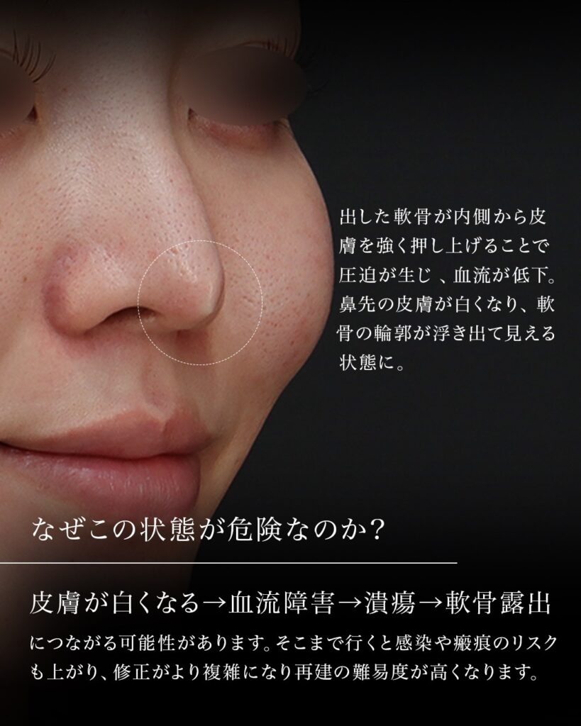 鼻整形他院修正 鼻先高すぎ改善 皮膚血流不全 鼻フル 猫貴族手術 ハンプ切除 術後1年 前田翔医師症例