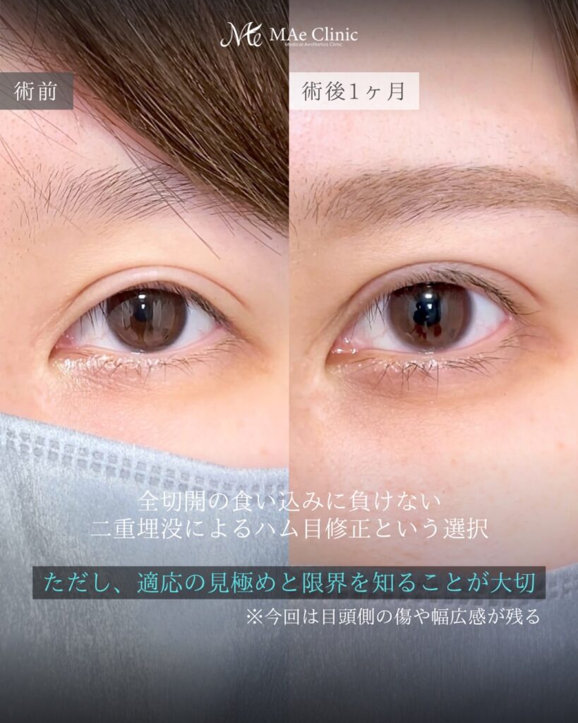 二重全切開後修正 二重埋没裏留め2ループ まつ毛生え際 裏ハムラ併用 前之園健太医師症例
