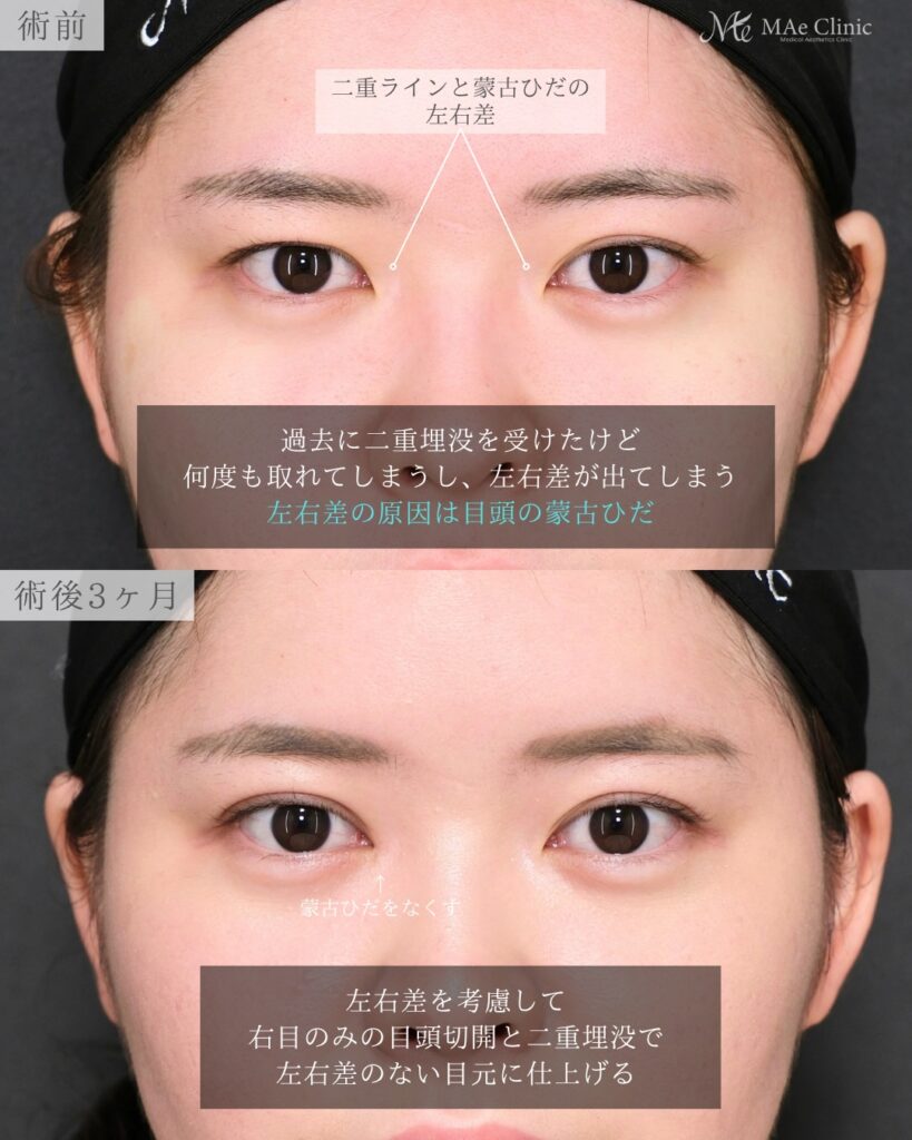 片目整形 右目目頭切開Z法 二重埋没裏留め 左右差改善 前之園健太医師症例