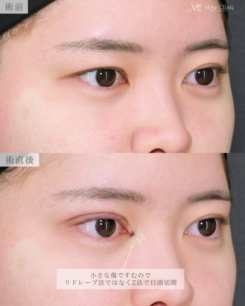 片目整形 右目目頭切開Z法 二重埋没裏留め 左右差改善 前之園健太医師症例