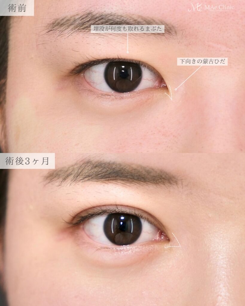 目頭切開Z法 二重埋没裏留め 最小限の傷跡 蒙古ひだ改善 前之園健太医師症例