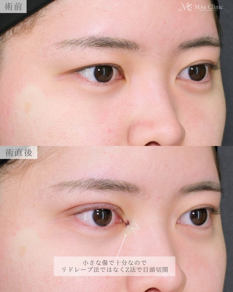 目頭切開Z法 二重埋没裏留め 最小限の傷跡 蒙古ひだ改善 前之園健太医師症例